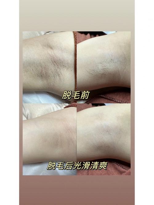 什么是冰点脱毛