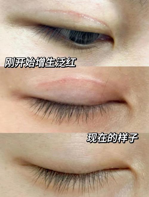 割双眼皮要注意什么