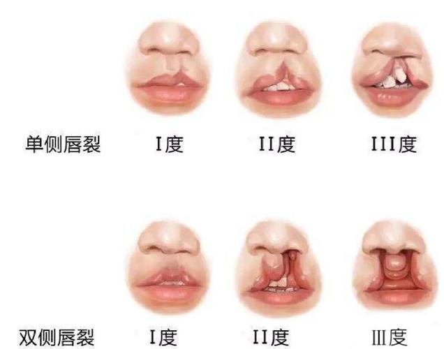 兔唇是什么样子