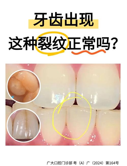 为什么牙齿有裂痕