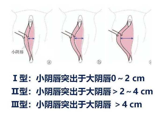 大阴唇什么颜色