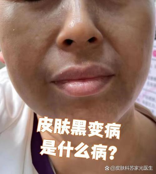 什么叫色素沉着
