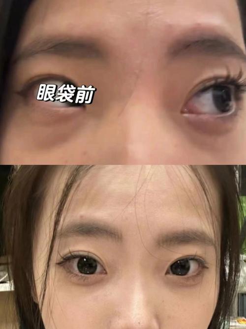 为什么眼袋那么重