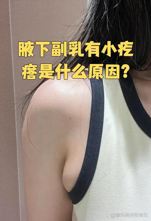 副乳有什么症状