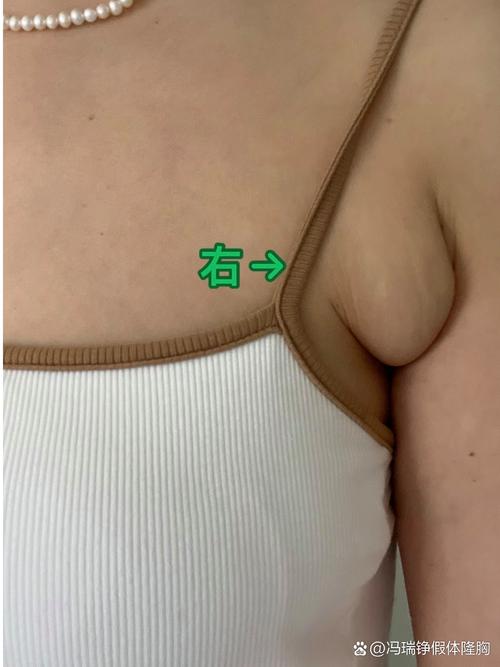 副乳有什么症状