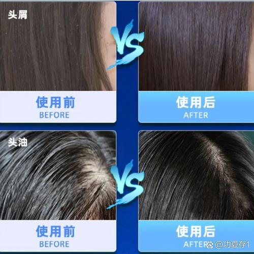 用什么可以去头屑