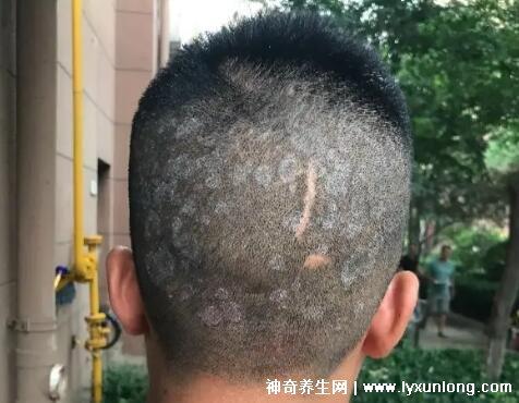 为什么会长头癣