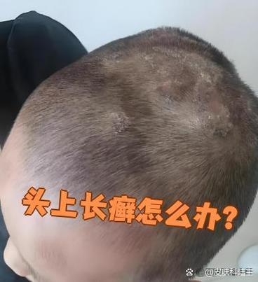 为什么会长头癣