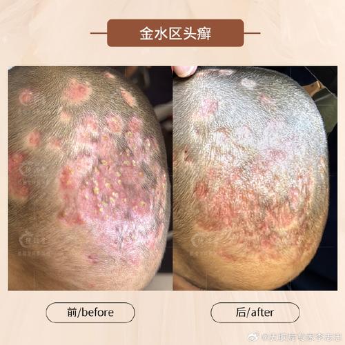 为什么会长头癣