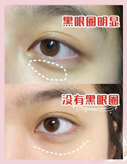 什么去黑眼圈最有效