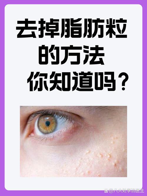 什么可以去除脂肪粒