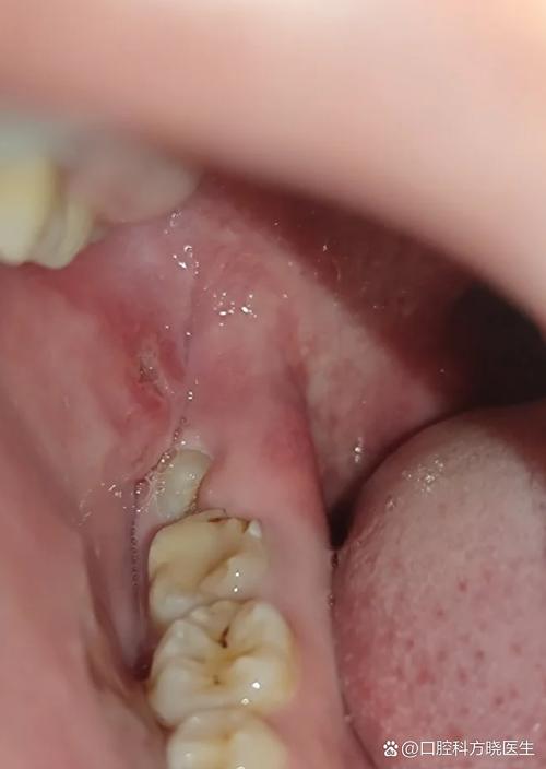 长智齿是什么症状