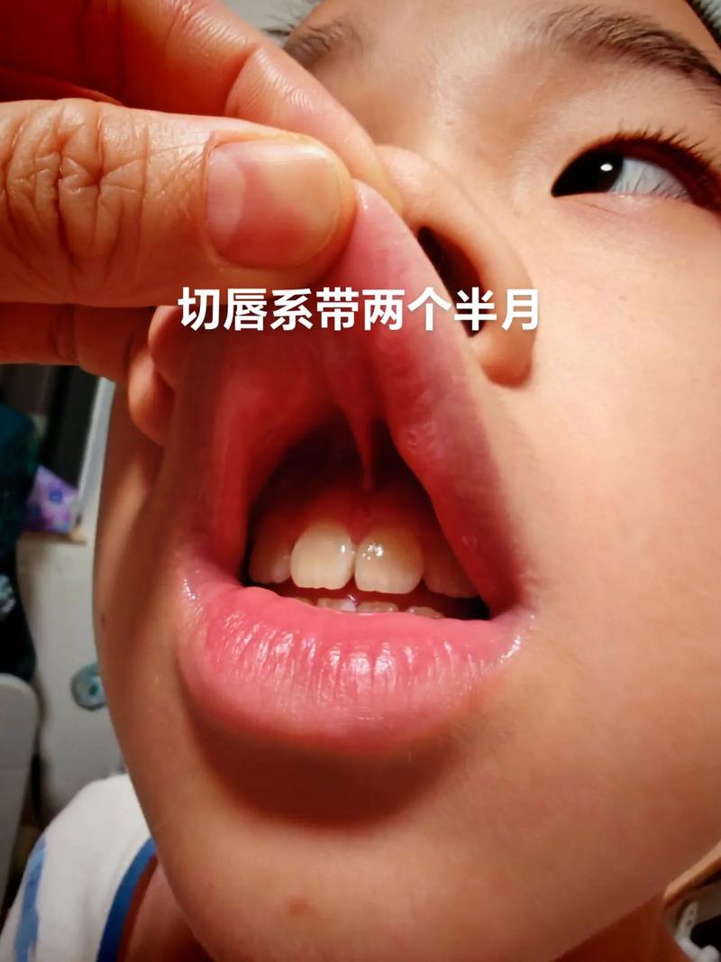 什么是唇系带