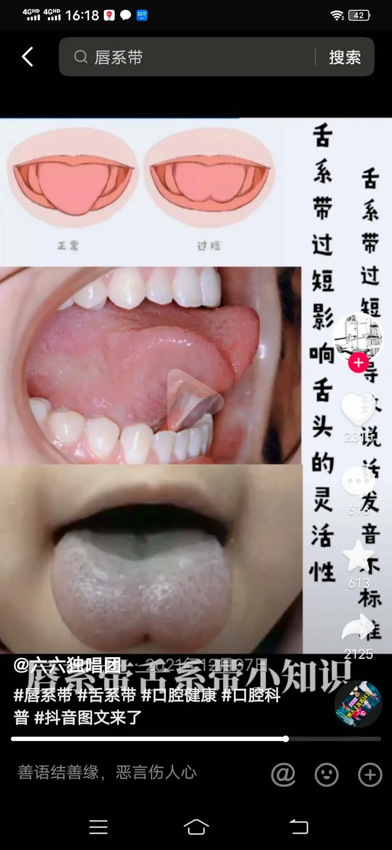 什么是唇系带