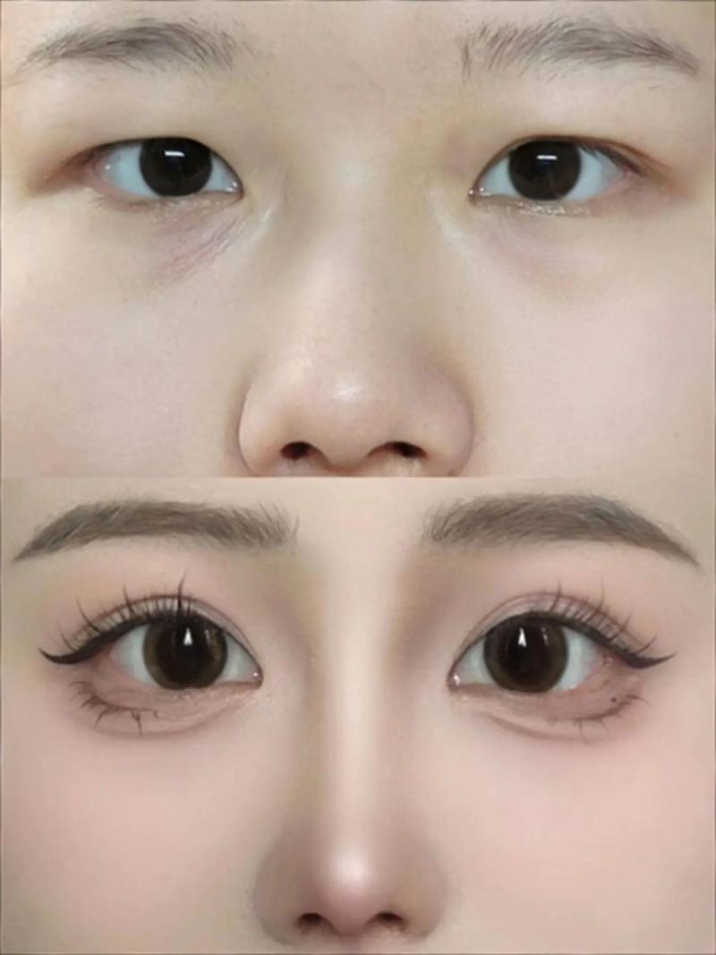 肿眼泡适合什么双眼皮