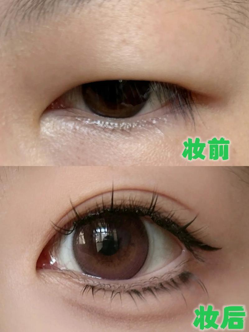 肿眼泡适合什么双眼皮