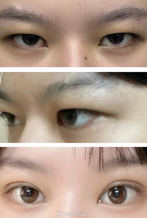 肿眼泡适合什么双眼皮