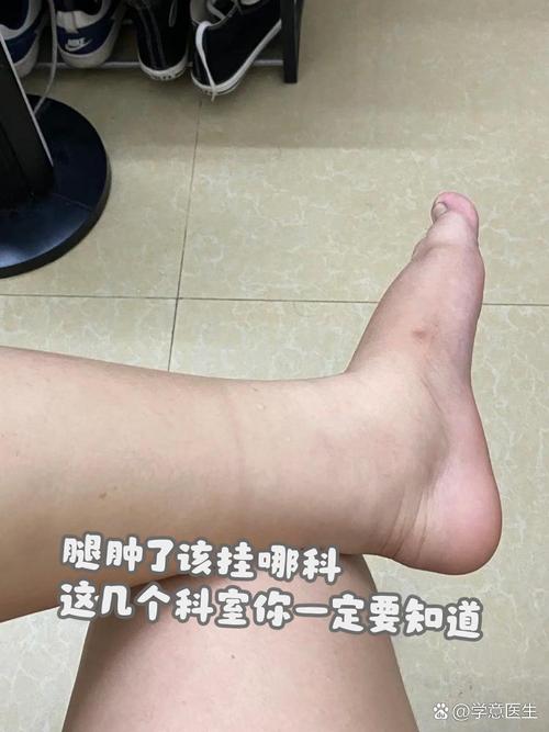 腿有点肿是什么原因