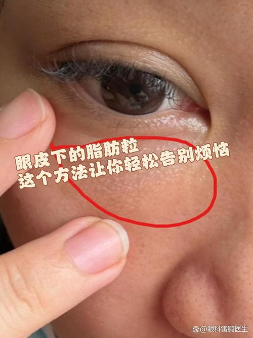 为什么会起脂肪粒