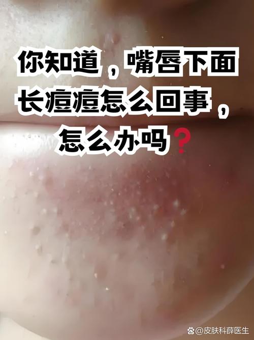 为什么嘴巴周围长痘