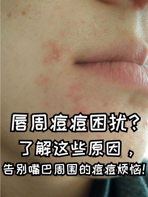 为什么嘴巴周围长痘
