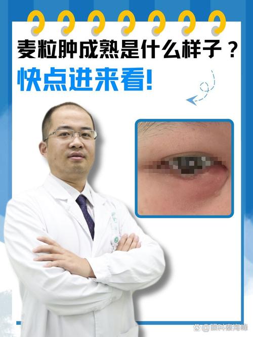 为什么眼睛长麦粒肿