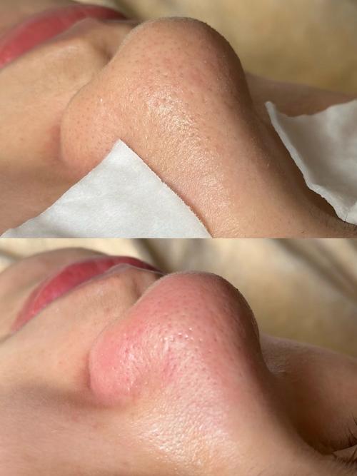 为什么鼻子会有黑头