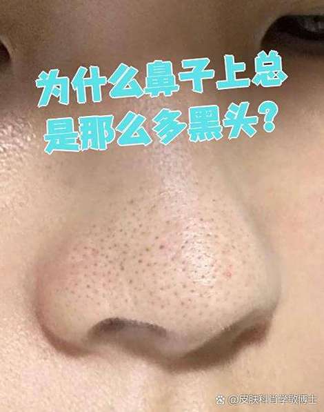 为什么鼻子会有黑头