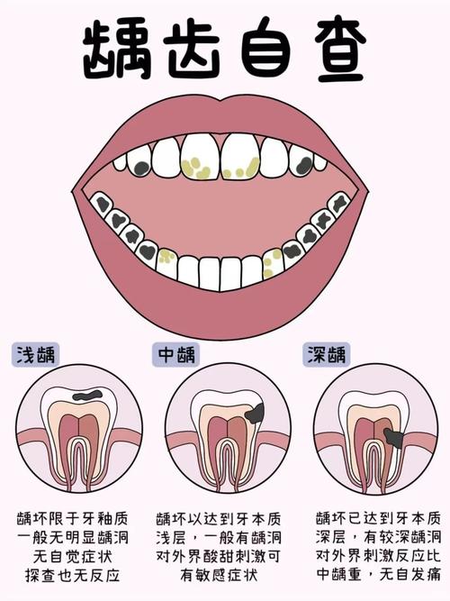小孩为什么会蛀牙