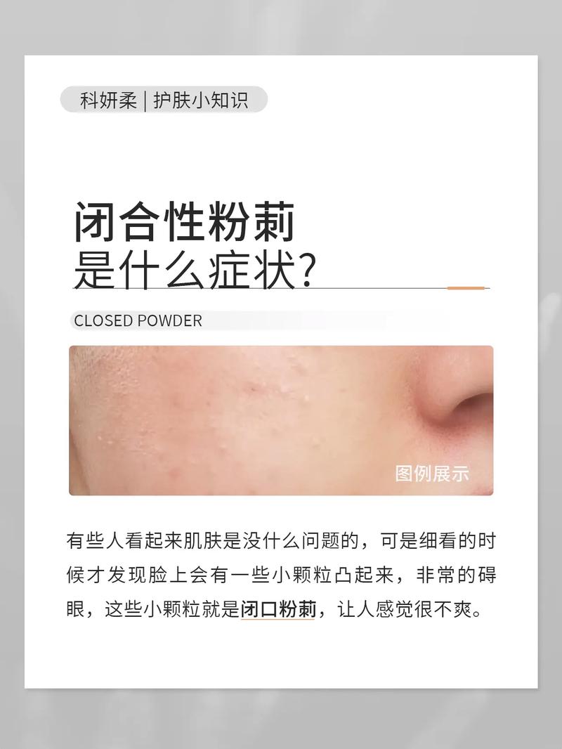 闭合性粉刺是什么