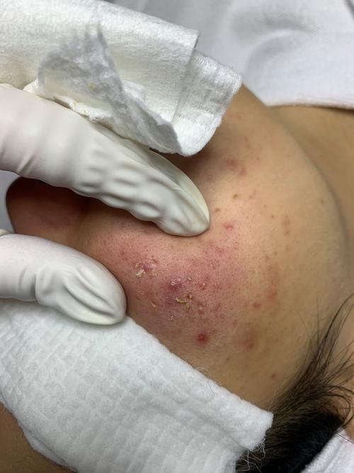 闭合性粉刺是什么
