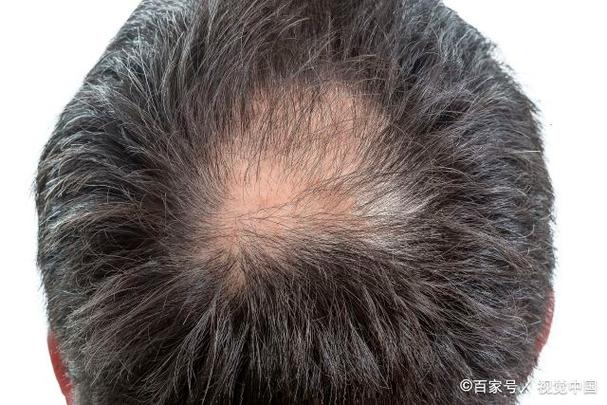 秃顶是什么遗传