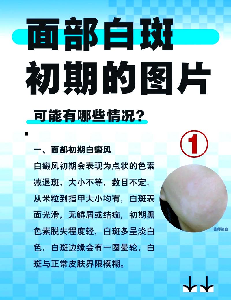 白斑和白斑有什么区别