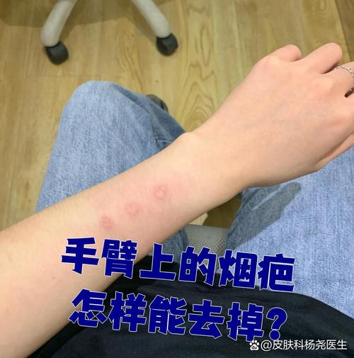 烟疤是什么意思