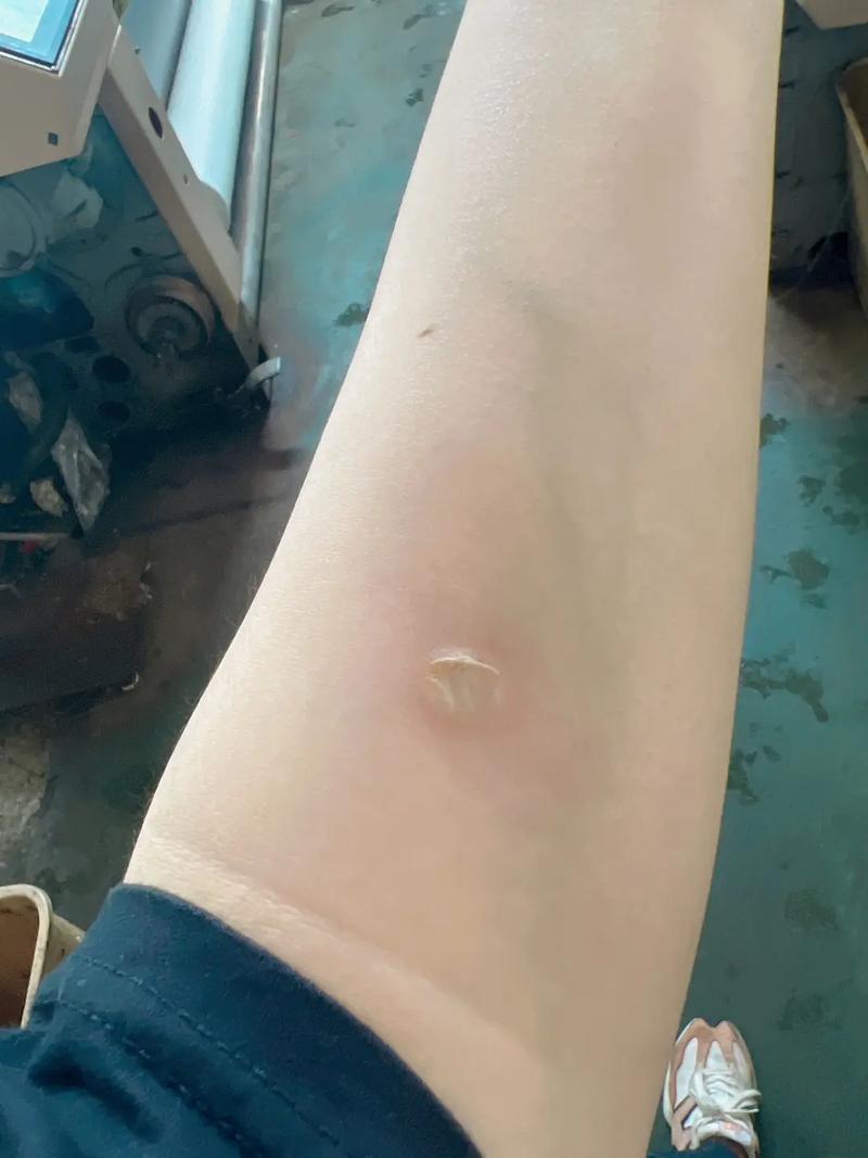 烟疤是什么意思