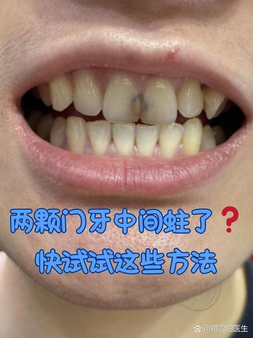 为什么门牙会蛀牙