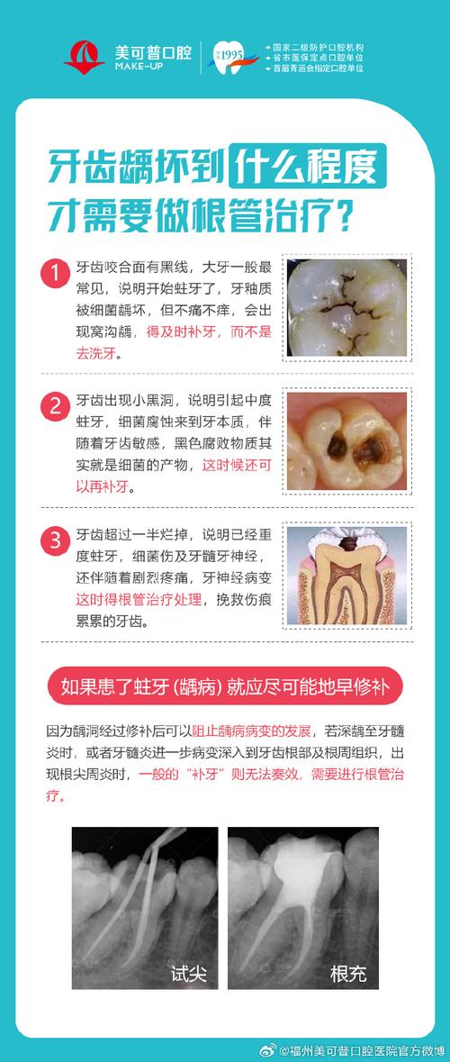 为什么门牙会蛀牙