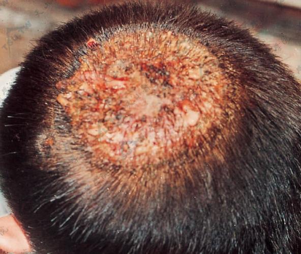 什么是头皮癣