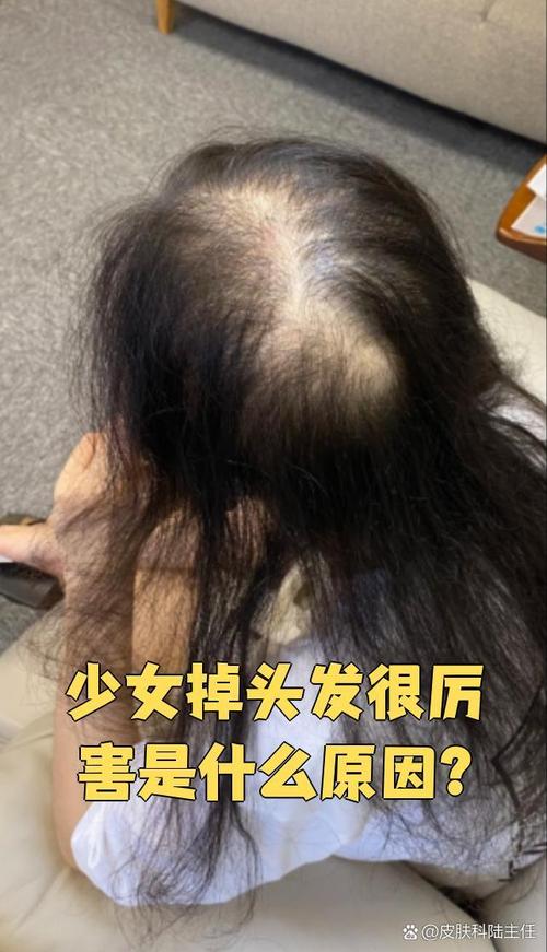 减肥为什么会掉发