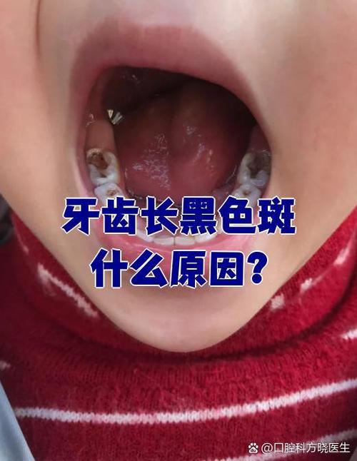 牙齿发黑是什么病