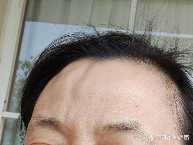 额头为什么会凹陷