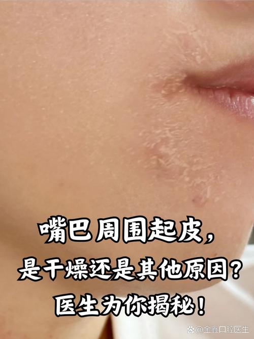 嘴唇脱皮是缺什么