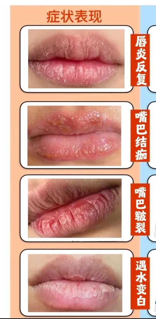 嘴唇脱皮是缺什么