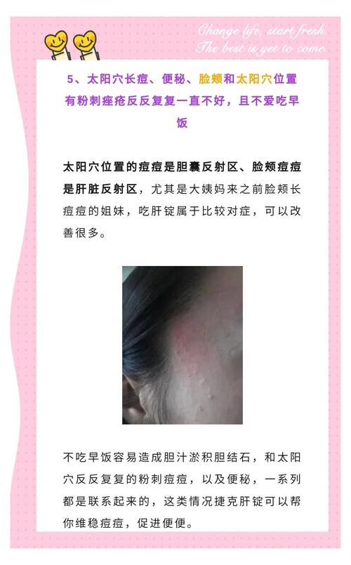 太阳穴为什么长痘痘