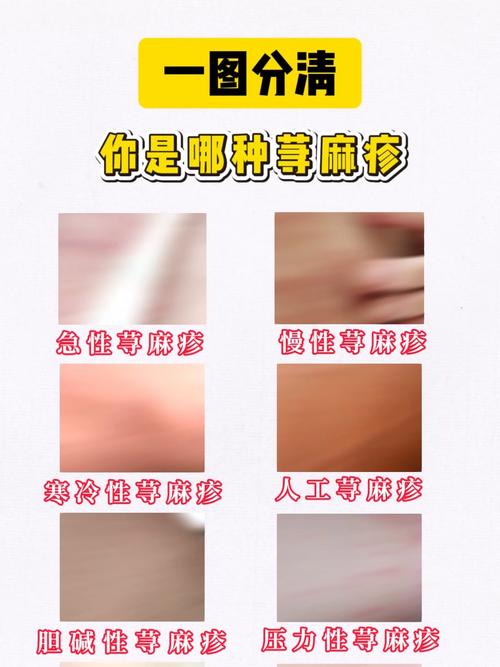 什么是荨麻疹图片
