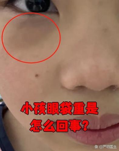 重眼是什么原因