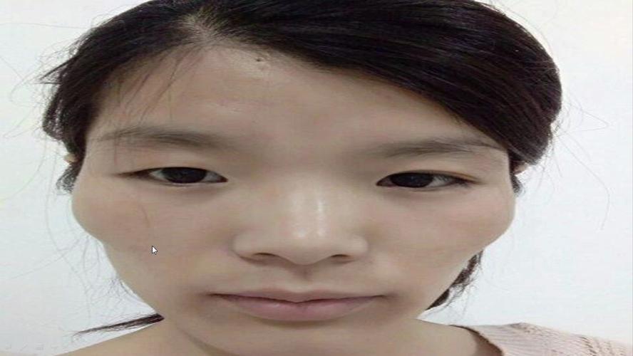 颧骨高是什么样子