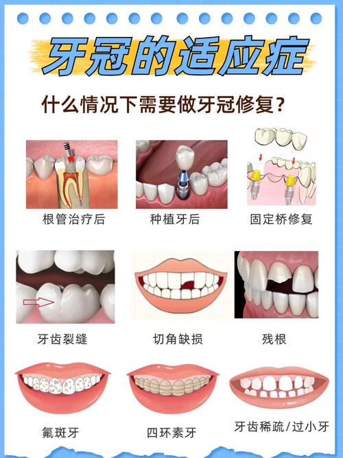做牙冠什么意思