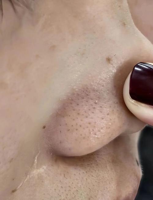 鼻子为什么会有黑头