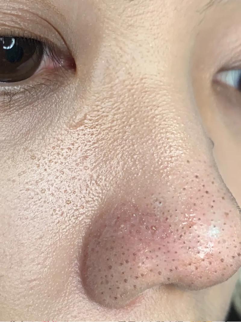 鼻子为什么会有黑头